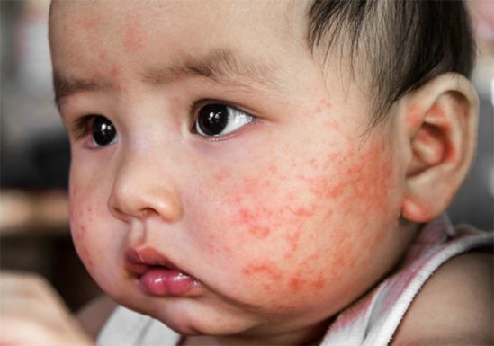 bệnh chàm khô ở trẻ em