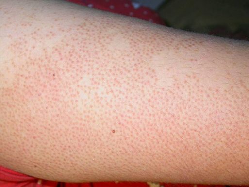 tìm hiểu về bệnh chàm khô nang lông