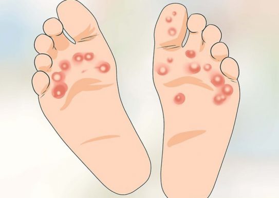tìm hiểu mụn nước ở bàn chân