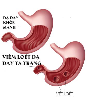 Giải thích cơ chế bệnh sinh trong viêm loét dạ dày tá tràng