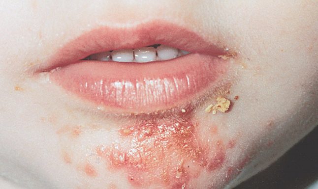 thuốc điều trị bệnh chốc lở