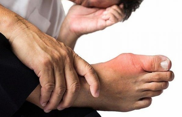 bệnh gút giai đoạn cuối