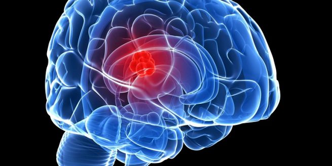 Các nhà nghiên cứu tiết lộ kế hoạch điều trị chứng khối u não nguy hiểm