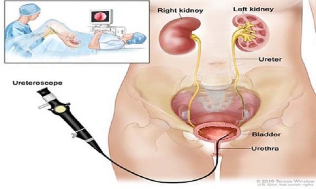 Nội soi sỏi niệu quản