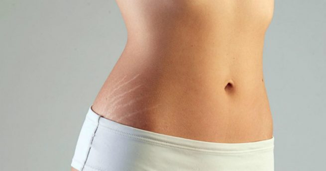 Rạn da có thể được điều trị nhanh, hiệu quả nhờ các phương pháp giải phẫu thẩm mỹ.