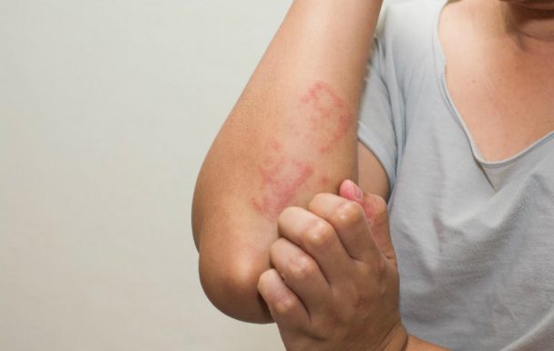 Nổi mẩn ngứa khi ra gió, rất có thể là triệu chứng của mề đay!