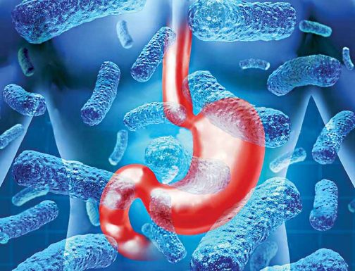 Người bị nhiễm vi khuẩn Hp có thể gây ung thư dạ dày