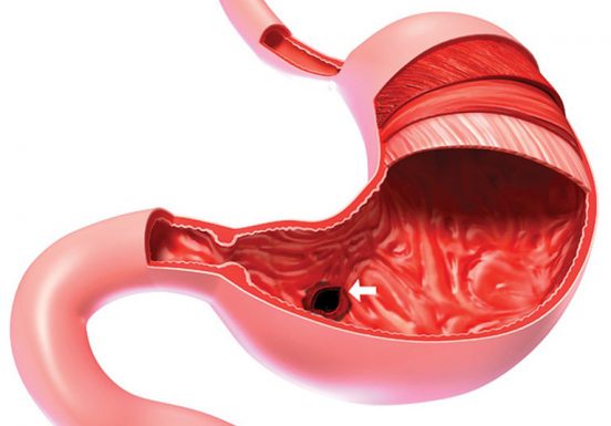 Viêm xung huyết hang vị dạ dày là gì? Có nguy hiểm không?