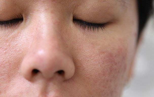 viêm nang lông ở mặt