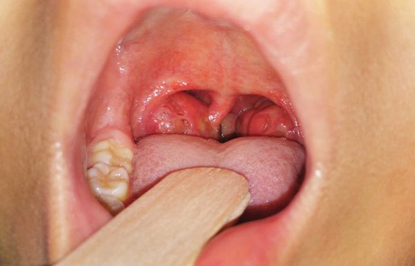 viêm amidan mãn tính có nguy hiểm không