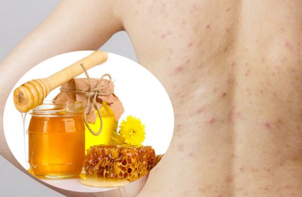 trị viêm lỗ chân lông bằng mật ong