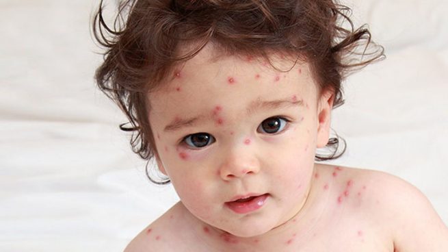 Trẻ bị nổi mẩn đỏ ở đầu là do đâu?