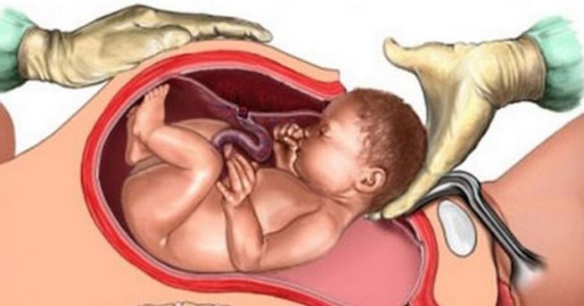 Nguyên nhân gây viêm nội mạc tử cung sau sinh