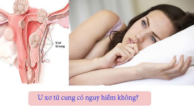 U xơ tử cung có nguy hiểm không? Biến chứng gì?