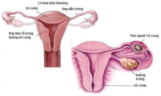 Mang thai ngoài tử cung là gì?