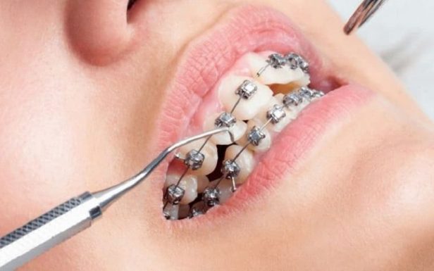 Niềng răng bị tụt lợi có nguyên nhân do đâu và các cách khắc phục