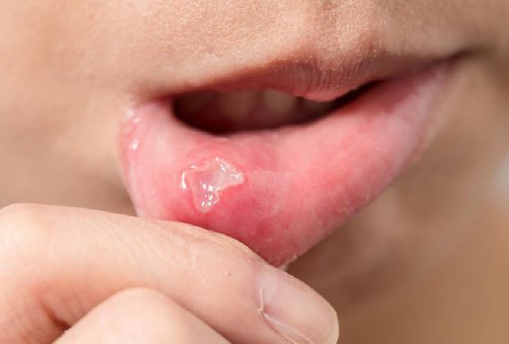 Nhiệt miệng là gì? Các biểu hiện thường gặp